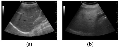 Mild Fatty Liver Ultrasound Hot Sex Picture