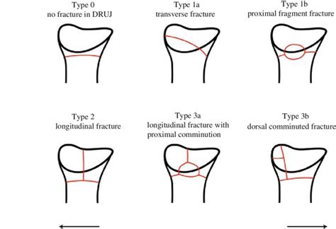 Simple fracture, Fracture, Comminuted fracture