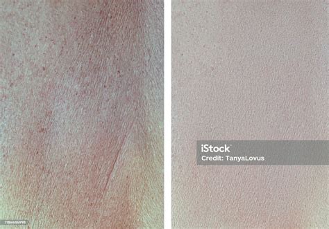 Wrinkle Skin Before And After Treatment Stock Photo - Download Image Now - Aging Process ...