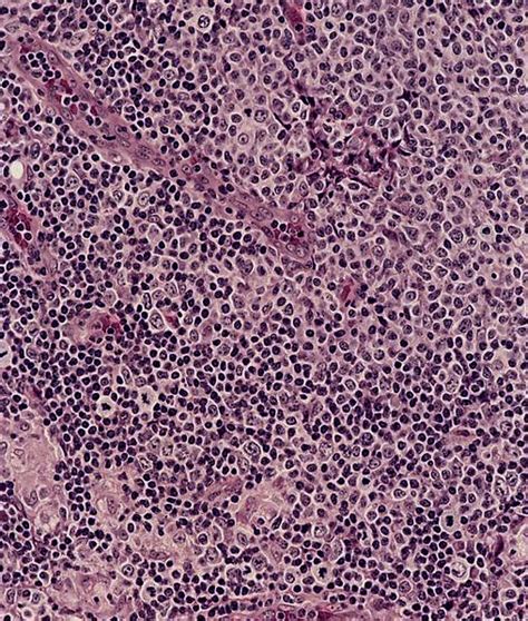 Pathology Outlines Toxoplasmosis