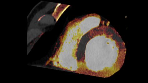 The Difference Between Images And Answers With Dual Energy Ct Siemens