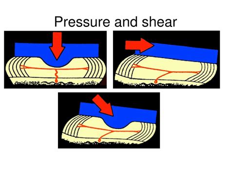 Ppt Pressure Ulcer Prevention And Management Powerpoint Presentation