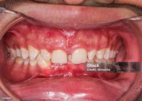 Gingival Enlargement Red Color Gingivitis And Diastema Stock Photo