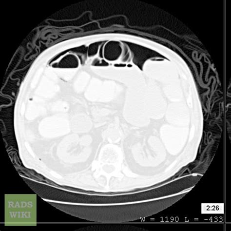 Pneumoperitoneum Wikidoc