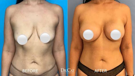 Breast Implants Over Or Under The Muscle What To Know