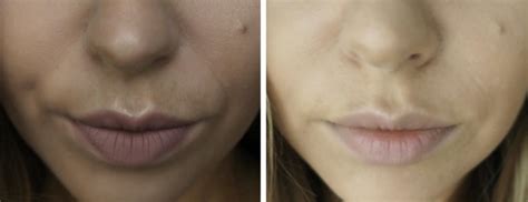 Nasolabial Fold Filler | Essence of Beauty: Skin Health & Aesthetics