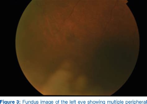 Figure From Bilateral Acute Retinal Necrosis Associated With