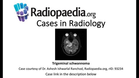 Trigeminal Schwannoma Radiopaedia Org Cases In Radiology Youtube