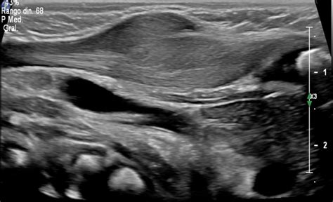 06 Fibromatosis Colli Tortícolis Congénita Ceus Docencia