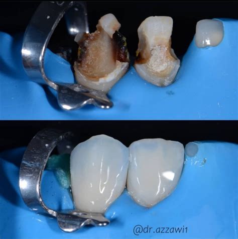 Kunststofffüllung Kompositfüllung Ästhetische Frontzahnfüllungen