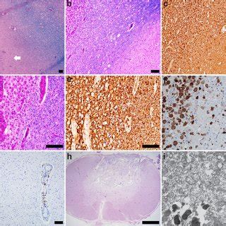 Histopathologic Findings Of Brain At Autopsy Paraffin Embedded