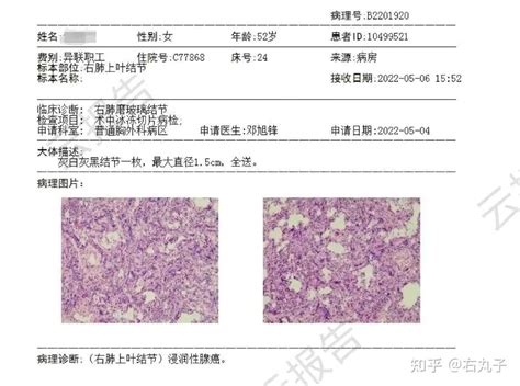 磨玻璃结节微浸润到浸润性腺癌？不用担心，一样手到擒来报平安 （转载） 知乎