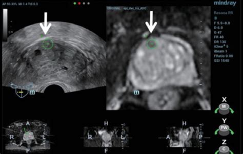 Ultrasound Journal 6 Improving Diagnostic Accuracy With TRUS MRI