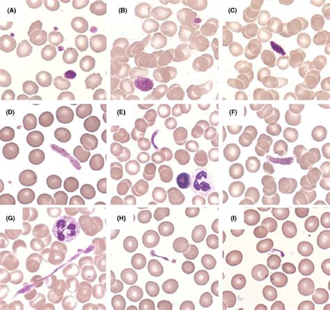Platelet morphology on peripheral blood films of patients with ... 