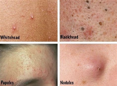 Different Acne Types And Ways To Identify Them การรักษาสิว การบำรุงผิว สิว