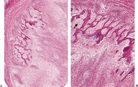 Low Power A And High Power B Histologic Specimens Of Myositis