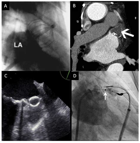 Devices Used For Left Atrial Appendage Occlusion A Percutaneous Left