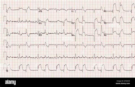 Myocardial Infarction Ecg Banque De Photographies Et Dimages Haute