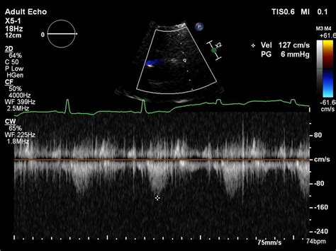 Postoperative Transthoracic Echocardiography Demonstrated A Mean