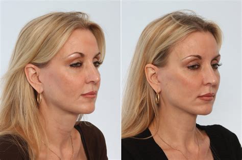 Neck Lift Photos Houston Tx Patient