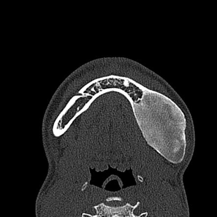 Fibrous Dysplasia Oral Cavity