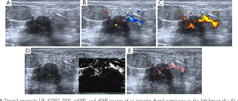 Figure 1 From Superb Microvascular Imaging For Evaluation Of