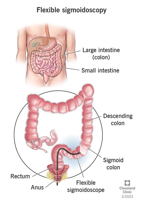 Flexible Sigmoidoscopy What Is It Purpose Prep Vs Colonoscopy