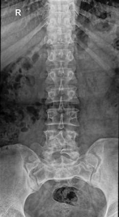 Spina Bifida Occulta Ultrasound