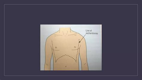 Fasciotomy & Escharotomy | PPT