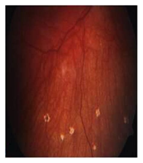 Fundus photograph showing depigmented fundus a sunset-glow fundus (a ...