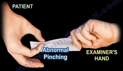 Froment’s Sign - Orthopedics Hand Nerve Injury Nabil Ebraheim Healthcare