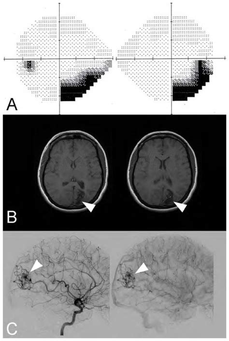 Right Homonymous Hemianopia Related To A Left Occipital Arteriovenous Download Scientific