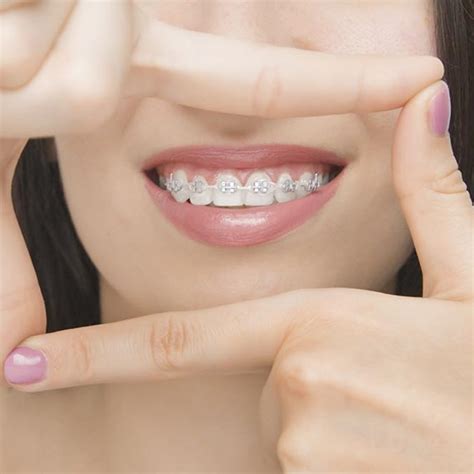 Ortodoncia Con Brackets En Bilbao Cl Nica Dental Santisteban