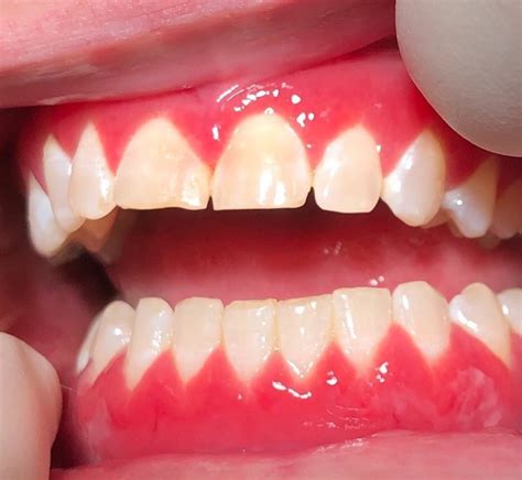 Erythematous Maxillary And Mandibular Gingivae Maxillary Gingivae Are