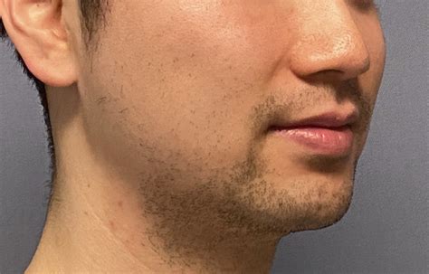 Male Custom Chin Implant Oblique 1 Dr Barry Eppley Copy Explore