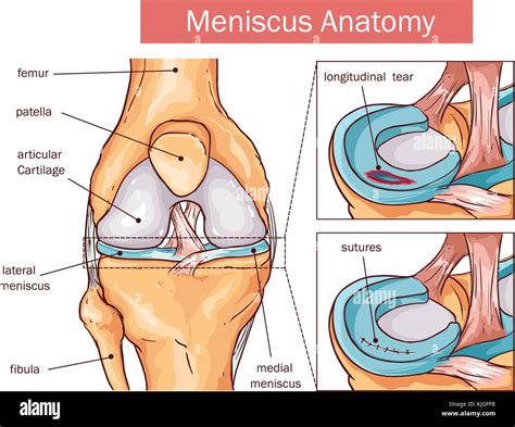 Vector Illustration Of A Meniscus Tear And Surgery Stock Vector Image