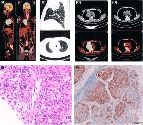 Lung Adenocarcinoma With An Uncommon Ccdc85a‐alk Fusion Responding To Alectinib A Case Report