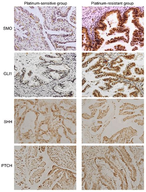 Immunohistochemical Staining Of SHH PTCH SMO And GLI1 Proteins In