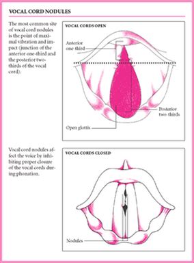 Symptoms and Causes - Vocal Nodules