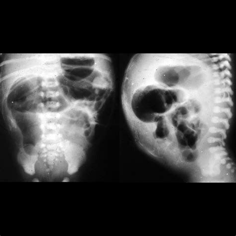 Complicated Meconium Ileus | Pediatric Radiology Reference Article ...