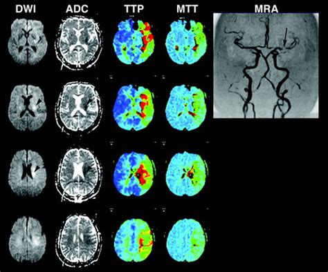 Comparative Overview Of Brain Perfusion Imaging Techniques Stroke