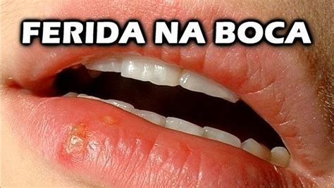 Ferida Na Boca O Que Pode Ser Buscar Sa De