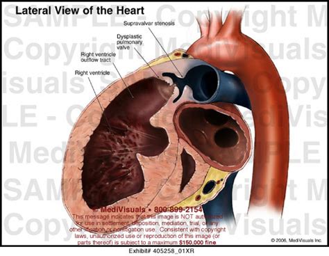 Lateral View Of The Heart Medical Illustration Medivisuals