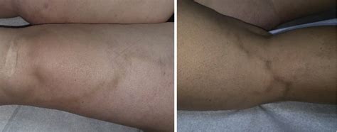 Reducing Hyperpigmentation After Sclerotherapy A Randomized Clinical