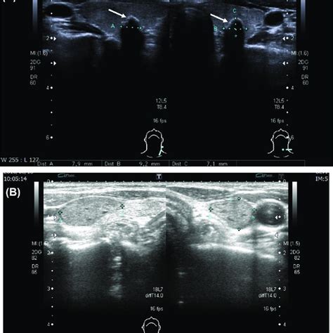 Ultrasonographic Picture Of The Thyroids A Left Thyroid Nodule With