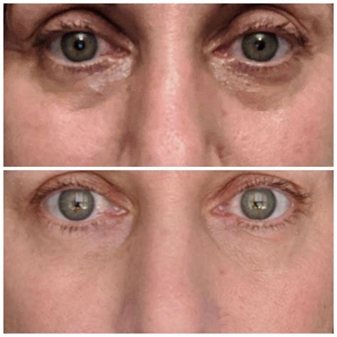 How To Get Rid Of Dark Circles Under Eyes Coastal Longevity Institute