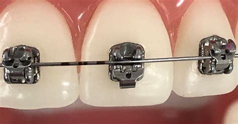 Different Parts Of Braces Orthodontic Terminology