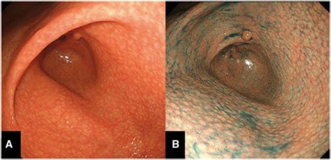 Journal Of Brown Hospital Medicine On Twitter Endoscopic Appearance