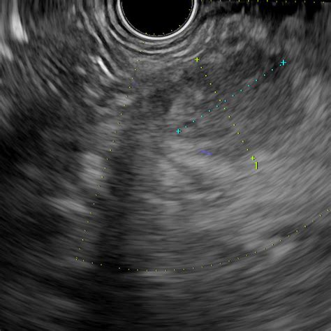 Endoscopic Ultrasound Shows The Pancreatic Mass Measuring 1 68 X 1 86