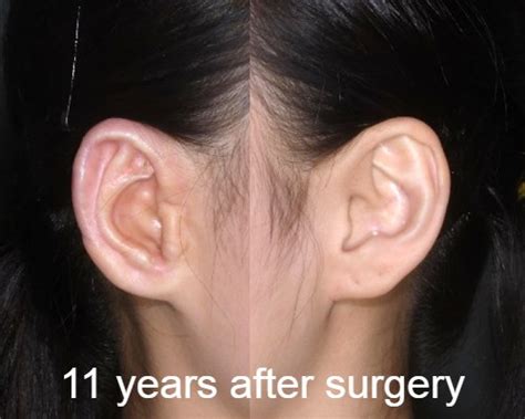 Gallery Ear Surgery Korea Cn